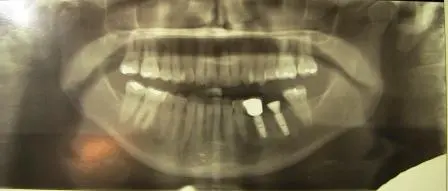 X-Ray of a patient's mouth
