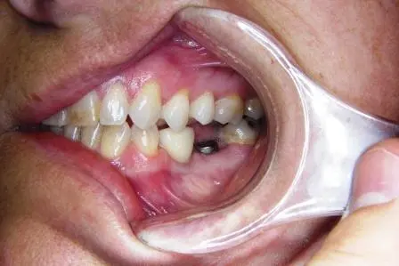 Close up of a patient's mouth with a missing tooth